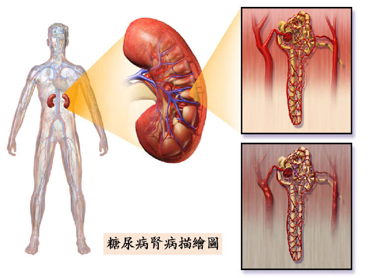 腎臟病介紹